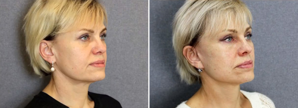 Лифтинг Мендельсона Владимир Наумов