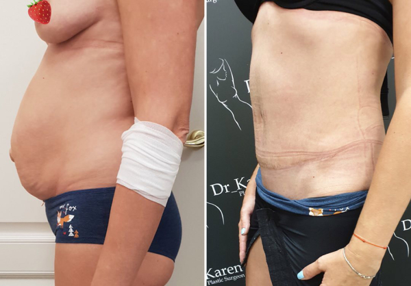 Фото пациентки до и после абдоминопластики у пластического хирурга Карена Пайтяна