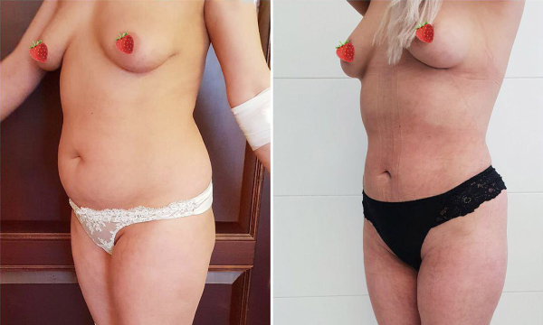 Фото пациентки до и после липосакции у пластического хирурга Карена Пайтяна