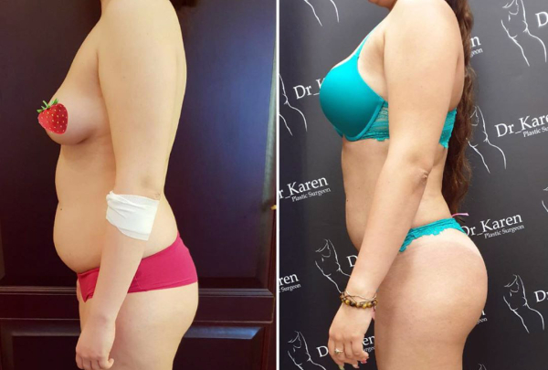 Фото до и после липосакции у пластического хирурга Карена Пайтяна