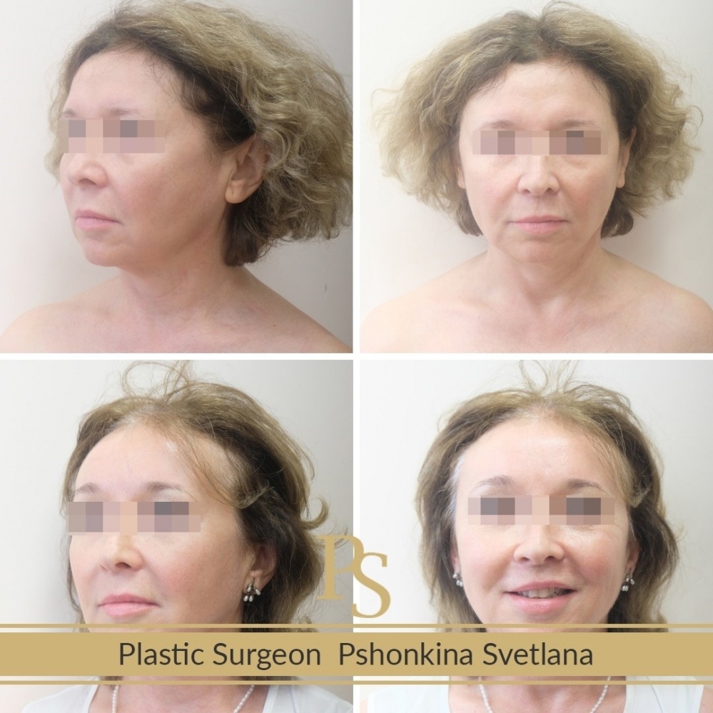Фотографии до и после Визаж-Лифта у доктора Светланы Пшонкиной