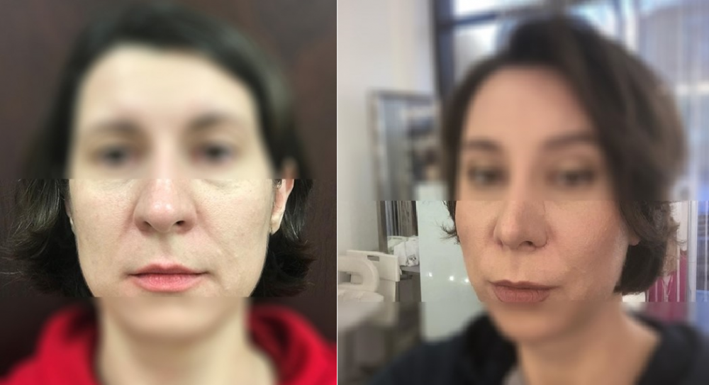 Довольная пациентка до и после Визаж-Лифта у доктора Светланы Пшонкиной