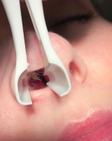 Хирургическая коррекция ноздрей