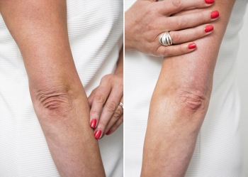 Пациент доктора Галины Хрущ после тредлифтинг рук