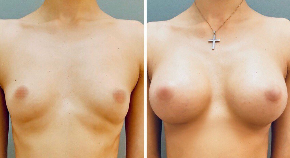 Увеличение груди Станислав Екимов