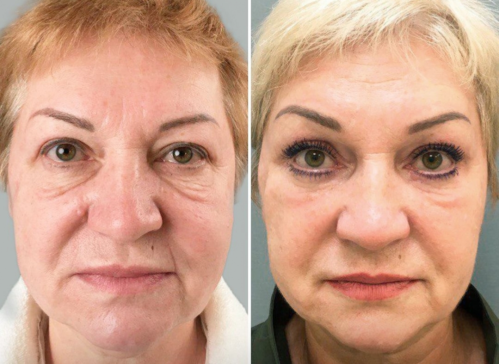 эндоскопическая периорбитопластика