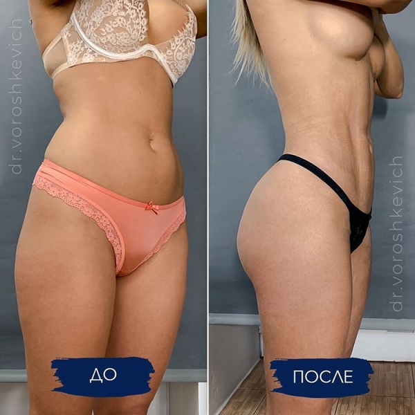 Пациентка до и после липомоделирования у доктора Ворошкевича