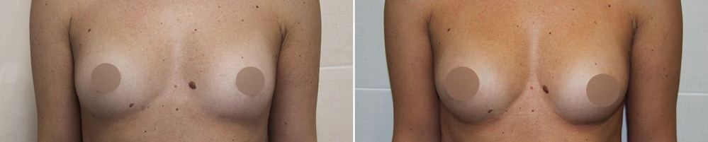 Фото до и после липотрансфера груди. Пациентка доктора Пенаева