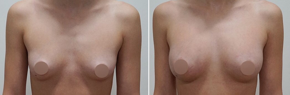 Фото до и после липотрансфера груди. Пациентка доктора Арслана Пенаева