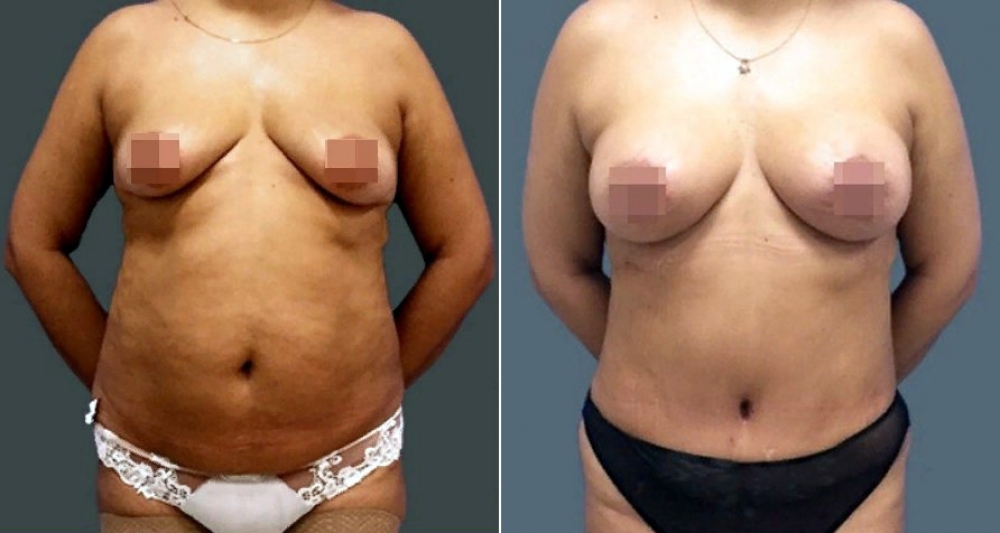 Абдоминопластика до и после Светлана Пшонкина