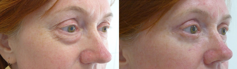 Круговая блефаропластика Андрей Михайлов