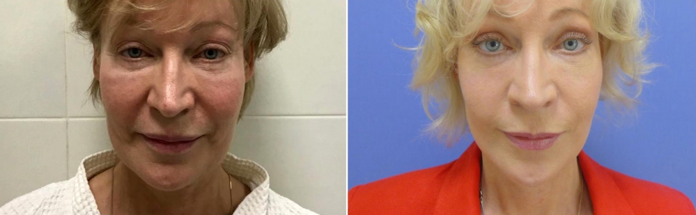 Андрей Михайлов блефаропластика