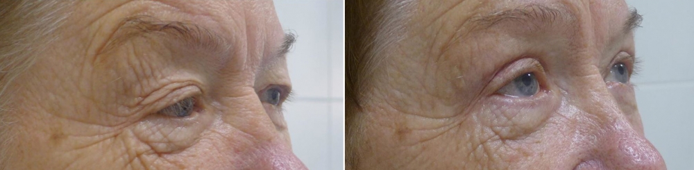 Верхняя блефаропластика Андрей Михайлов