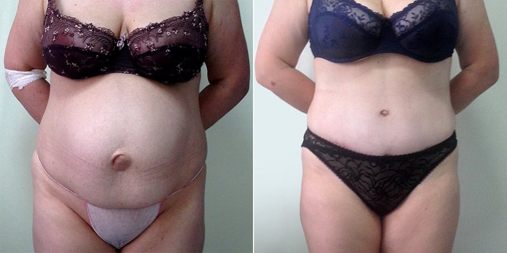 Абдоминопластика с удалением грыжи