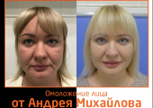 Пластический хирург Андрей Михайлов. Фото пациента до и после омоложения лица