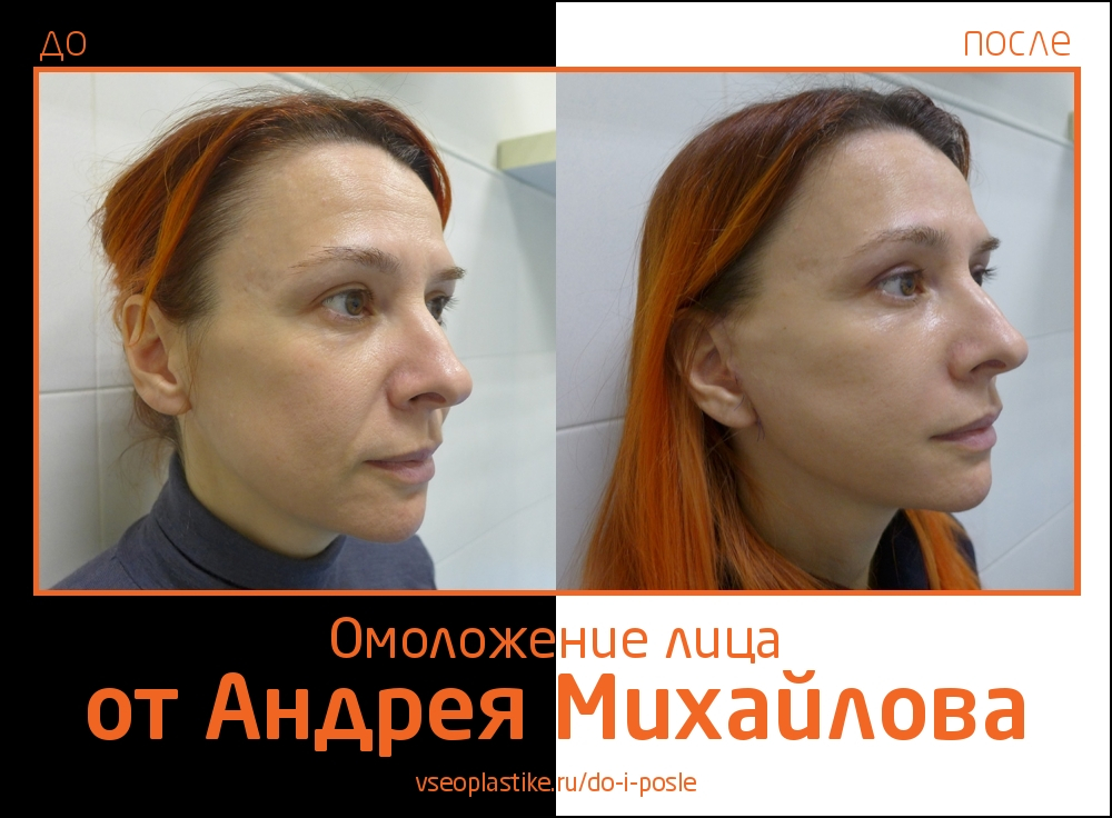 Доктор Андрей Михайлов. Фото пациентки до и после омоложения лица и шеи