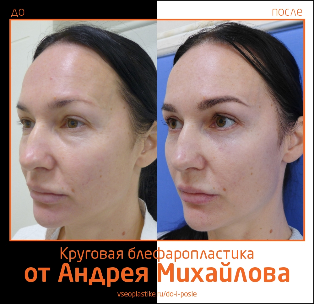Пациентка доктора Михайлова до и после круговой блефаропластики