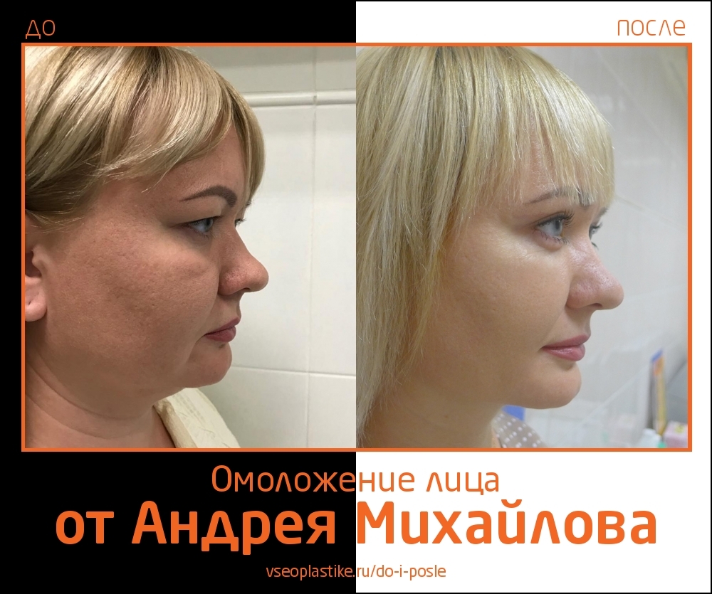 Андрей Михайлов. Фото пациентки до и после омоложения лица