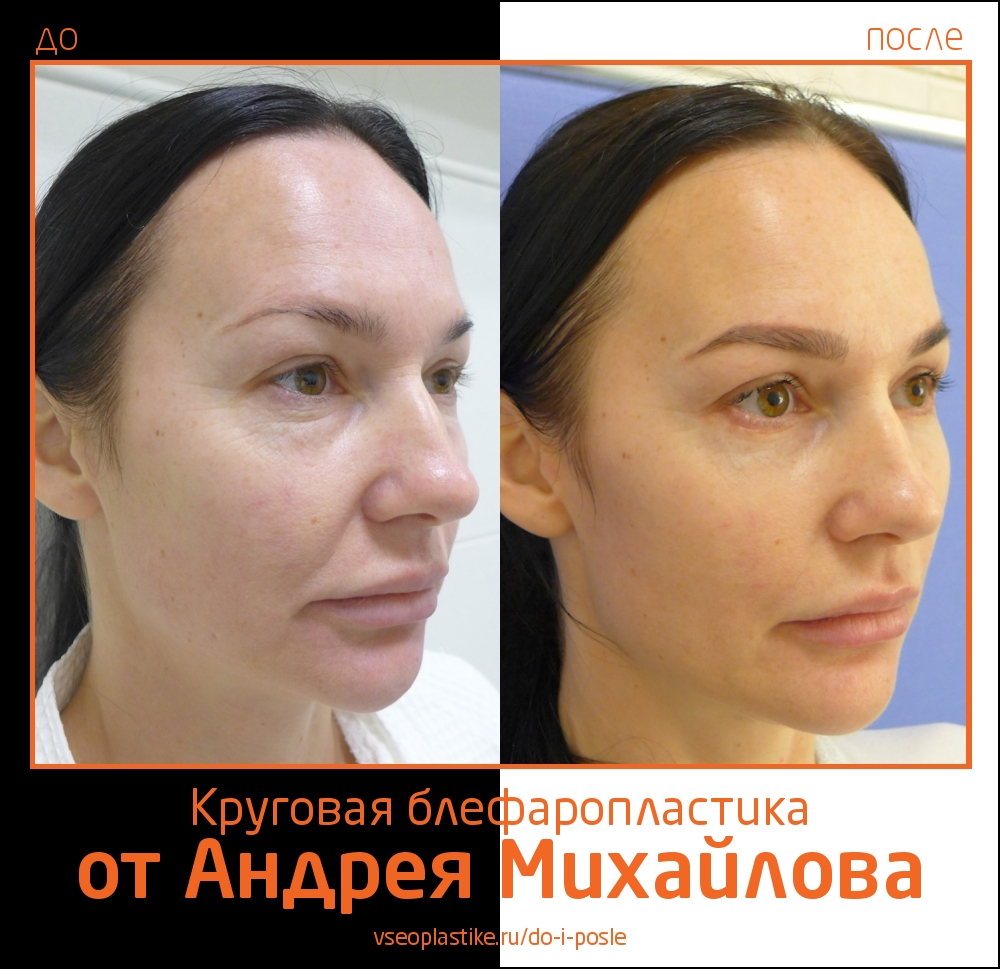 Пациентка доктора Андрея Михайлова до и после нижней и верхней блефаропластики