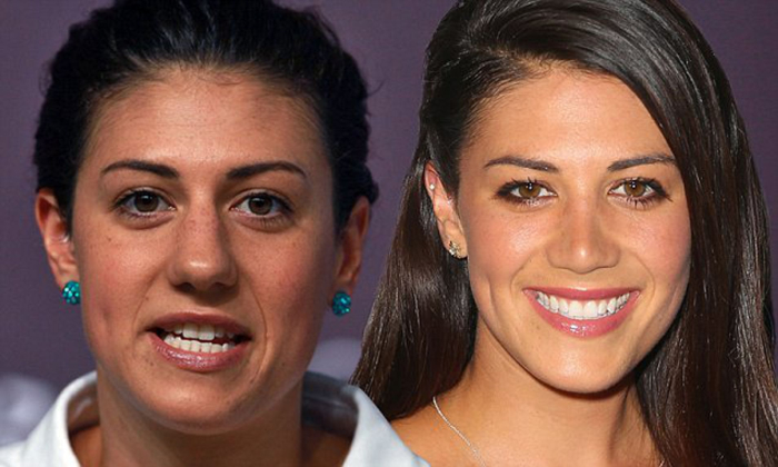  Пловчиха Стефани Райс до и после ринопластики