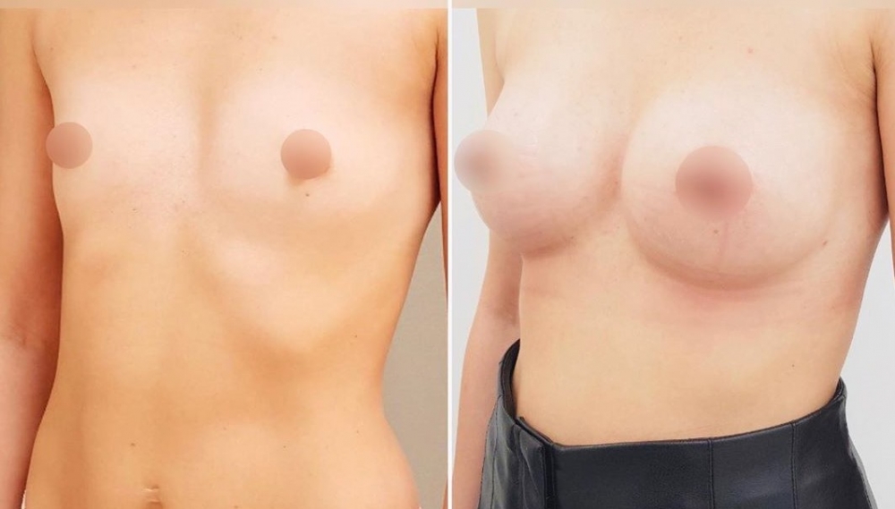 Увеличение груди у пластического хирурга Станислава Екимова