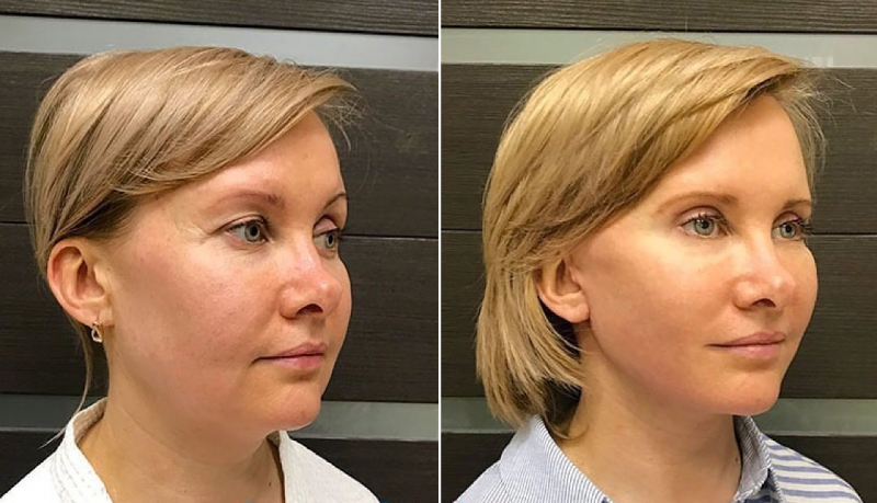 Подтяжка лица Ольга Ованесова