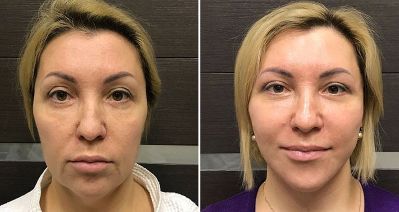 Ольга Ованесова подтяжка лица