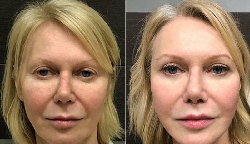 омоложение лица Ольга Ованесова