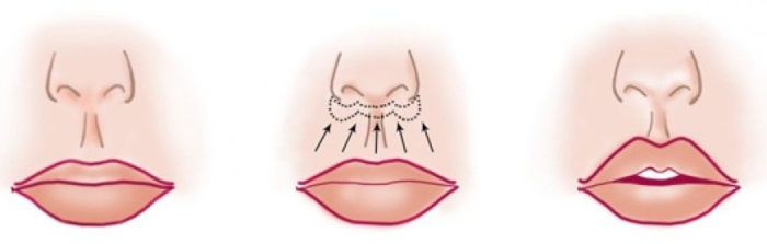 Разрезы при хейлопластике