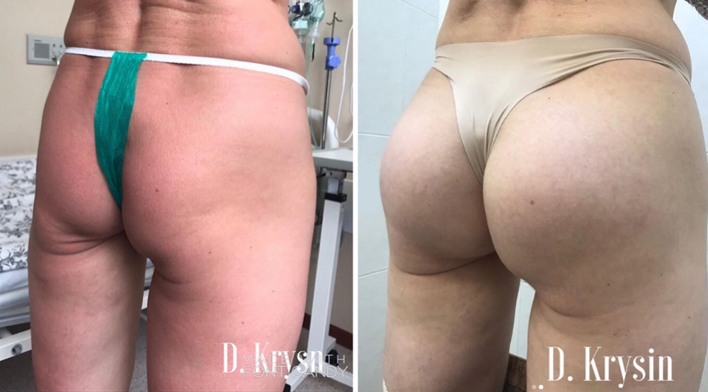 Глютеопластика до и после