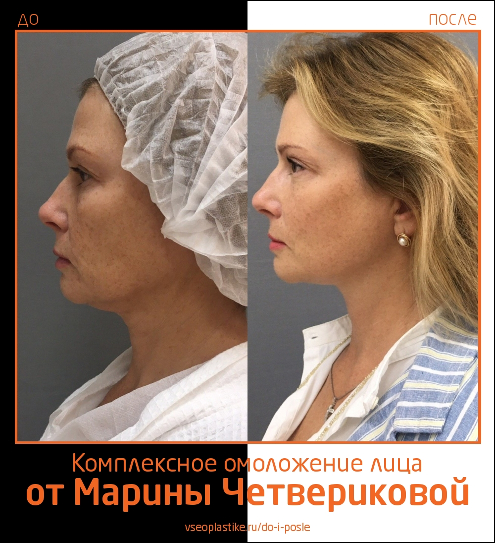 Марина Четверикова подтяжка лица