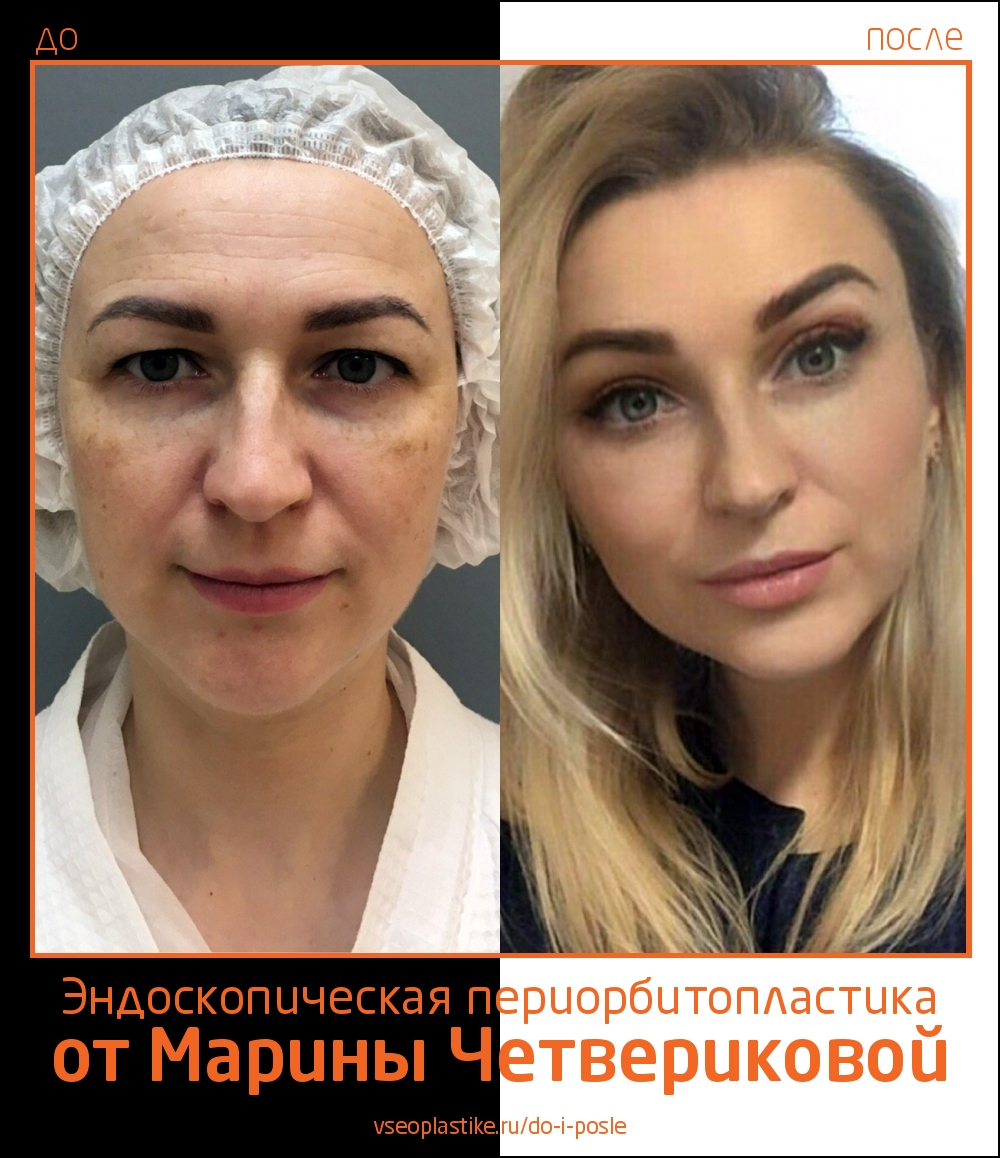 Пациентке выполнена эндоскопическая периорбитопластика и верхняя пластика век
