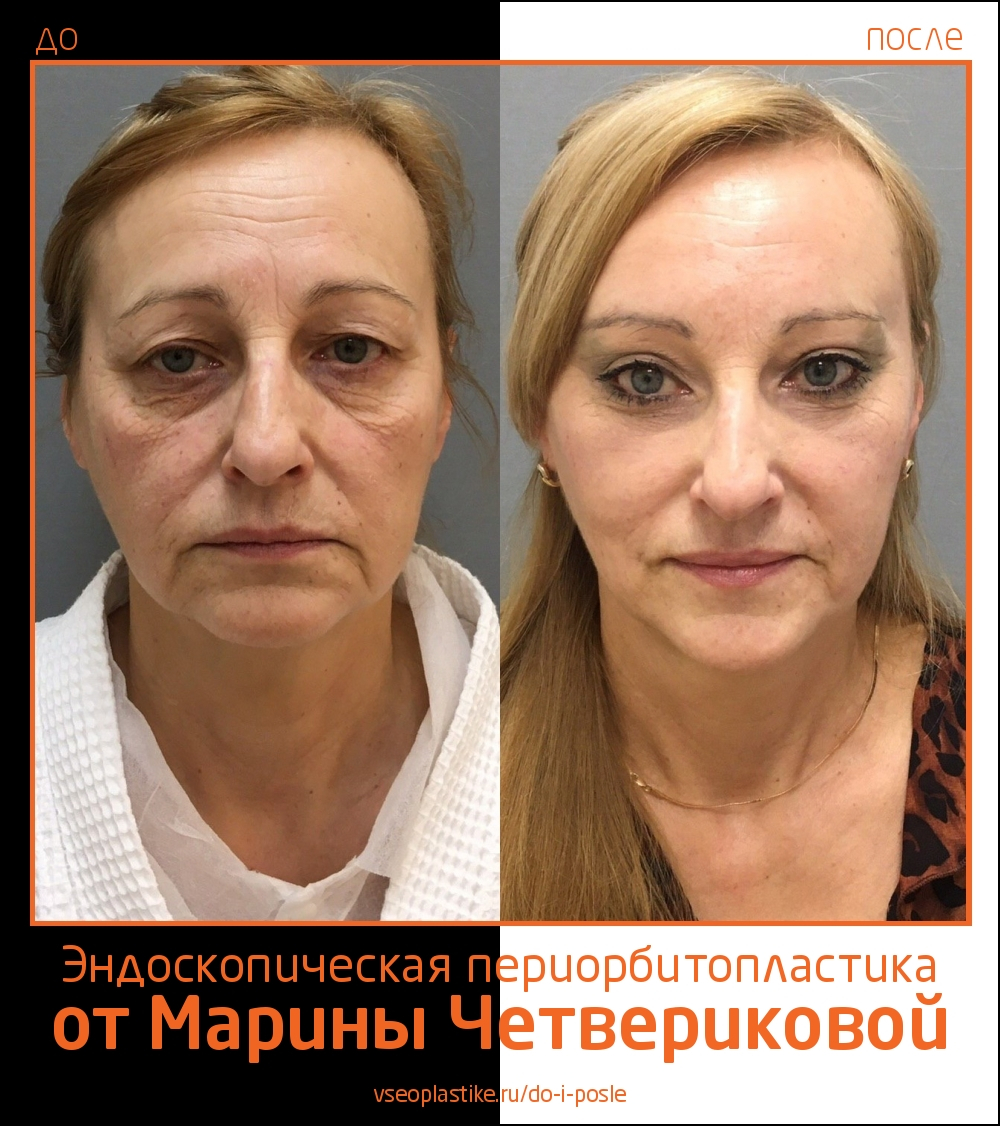 Марина Четверикова. Фото до и после эндоскопической периорбитопластики