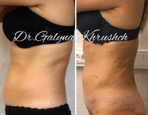 Галина Хрущ липосакция Москва