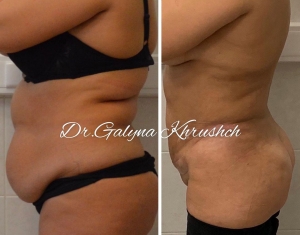 Галина Хрущ липосакция после родов