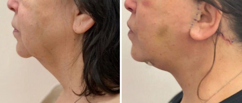 подтяжка лица Светлана Пшонкина