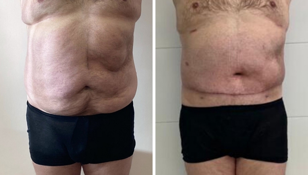 торсопластика Светлана Пшонкина