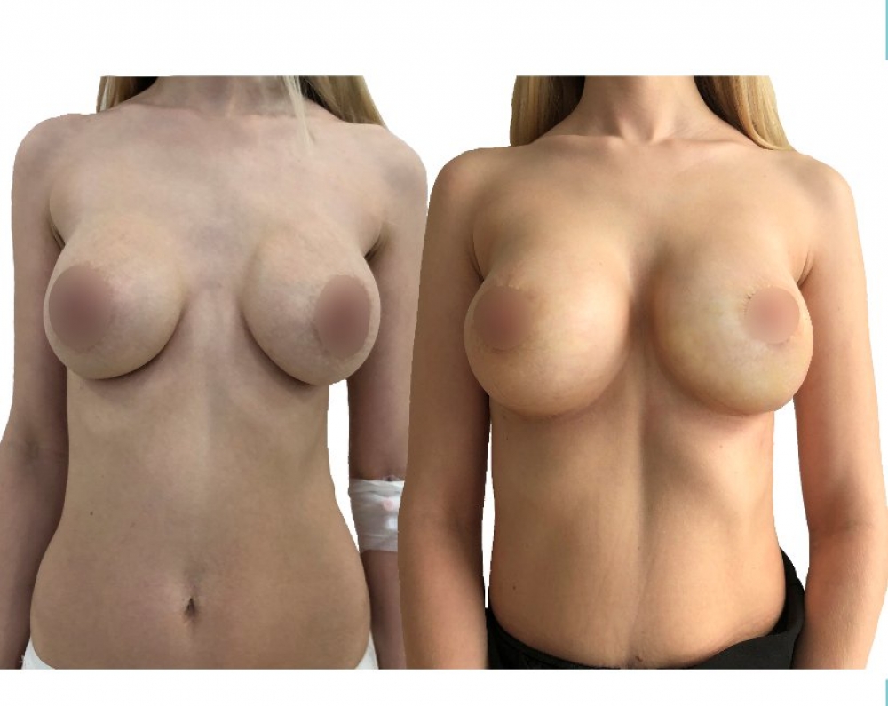 асимметрия груди у женщин форум фото 103
