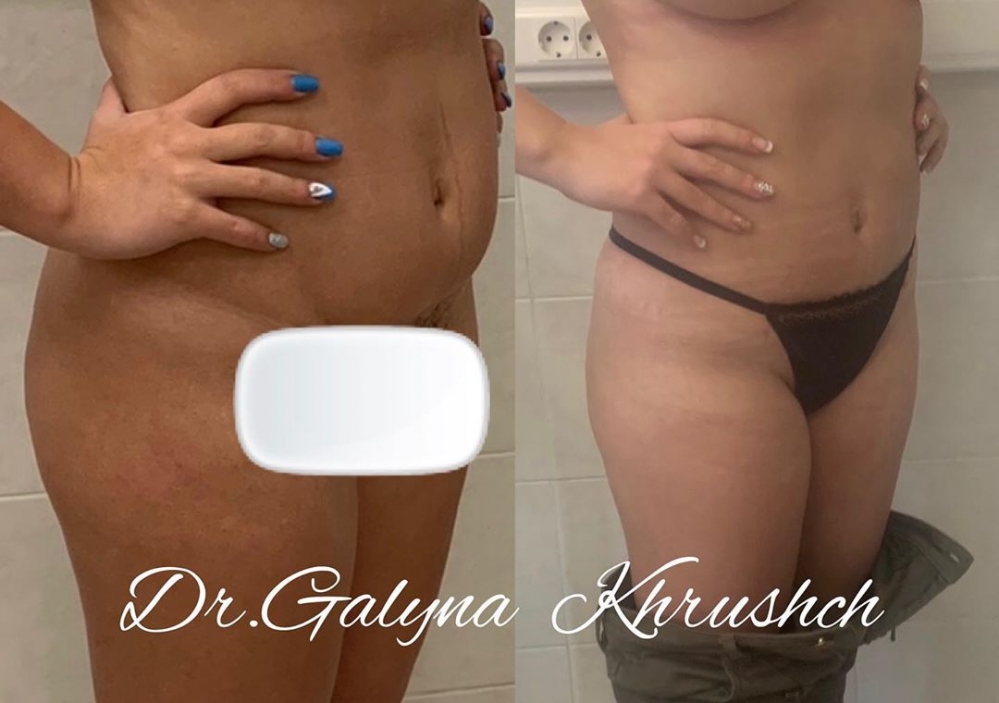 Пациентка до и после липосакции у доктора Галины Хрущ