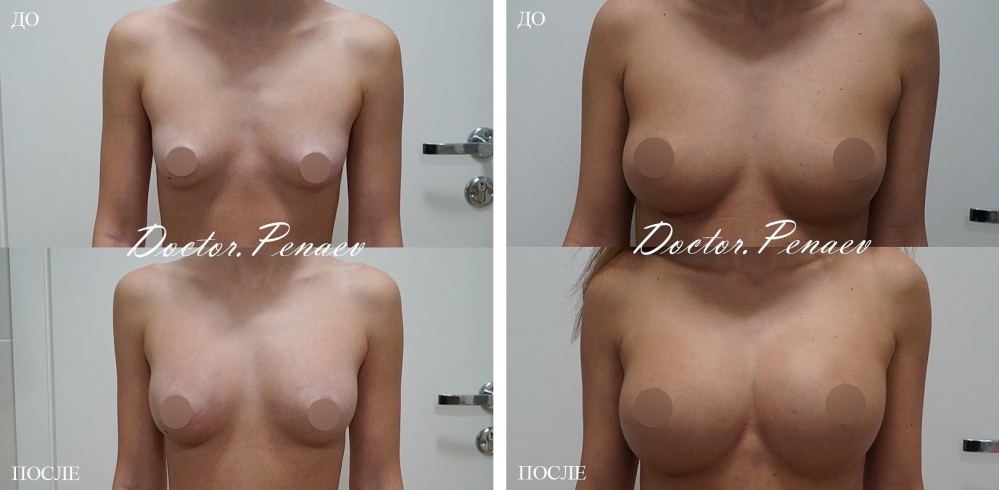 Пациентки до и после липотрансфера груди у пластического хирурга Арслана Пенаева