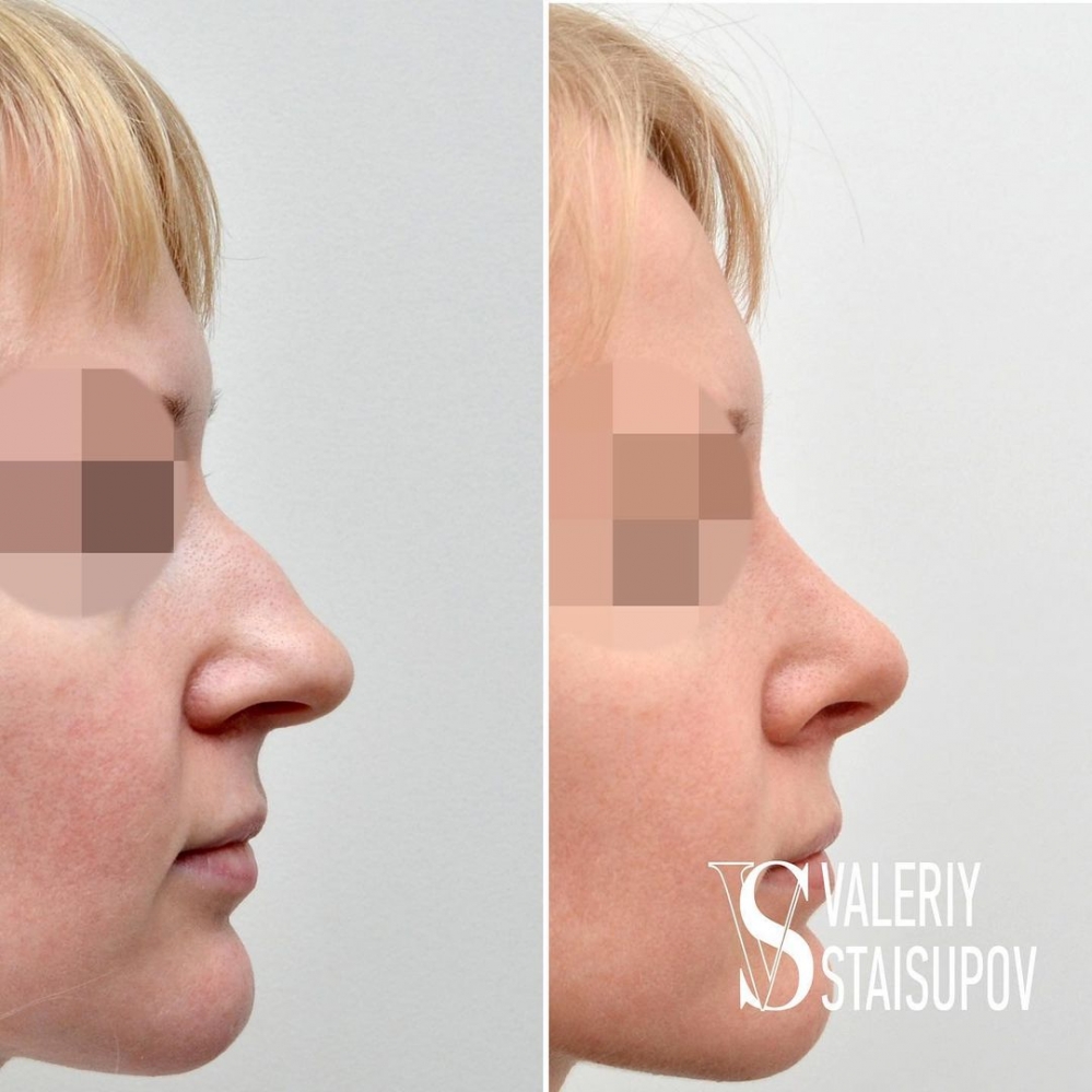 Валерий Стайсупов. Закрытая ринопластика