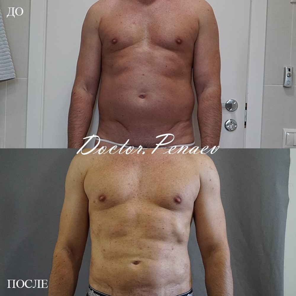 Пациент до и после VASER-липосакции тела