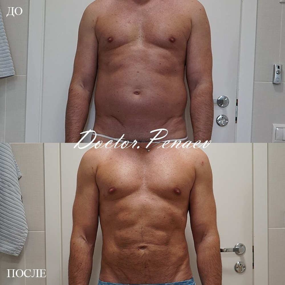 Пациент до и после VASER-липосакции тела через 6 месяцев