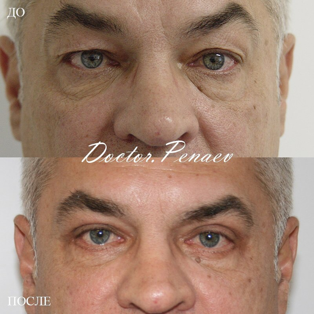 Пациент до и после круговой блефаропластики