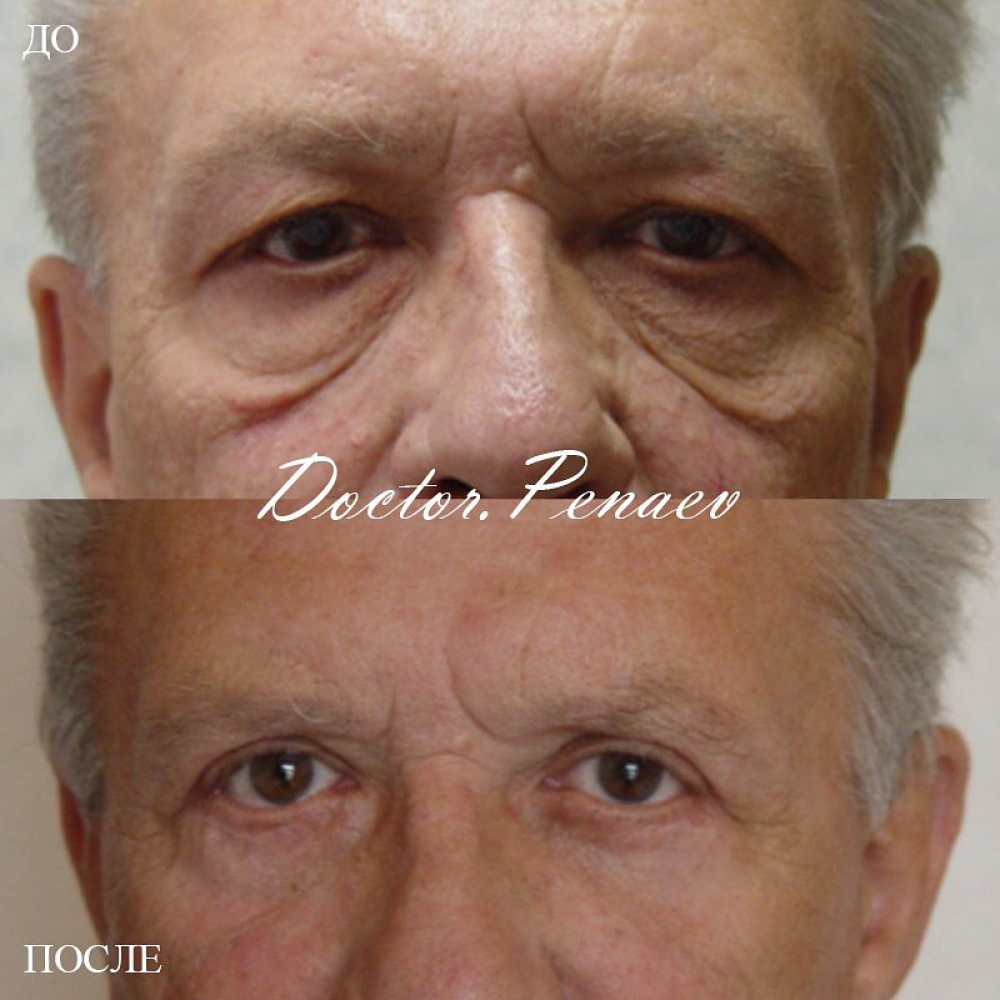 Пациент до и после круговой блефаропластики