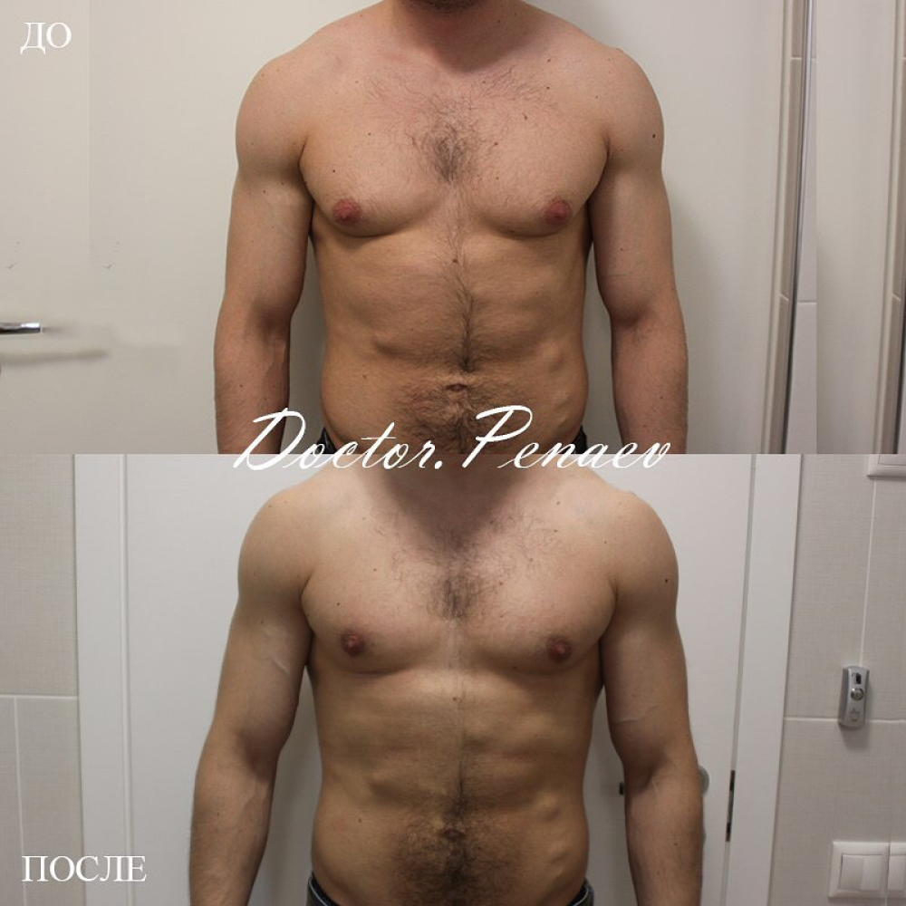 Пациент до и после устранения гинекомастии
