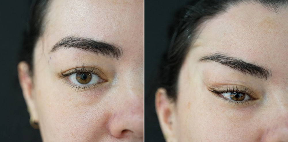 Фото до и после нитевой подтяжки Лисий взгляд