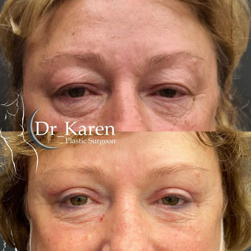 Пациентка пластического хирурга Карена Пайтяна. Фото до и после блефаропластики.