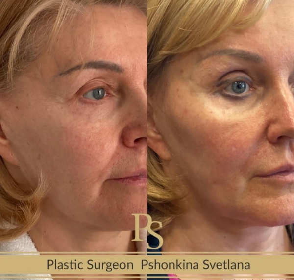 Пациентка Светланы Пшонкиной до и после Визаж Лифт