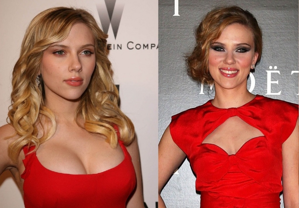 Scarlett johansson implants - 🧡 Scarlett Johansson Breast Reduction Plast....